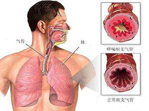 金槐三号——气管炎哮喘膏药说明书